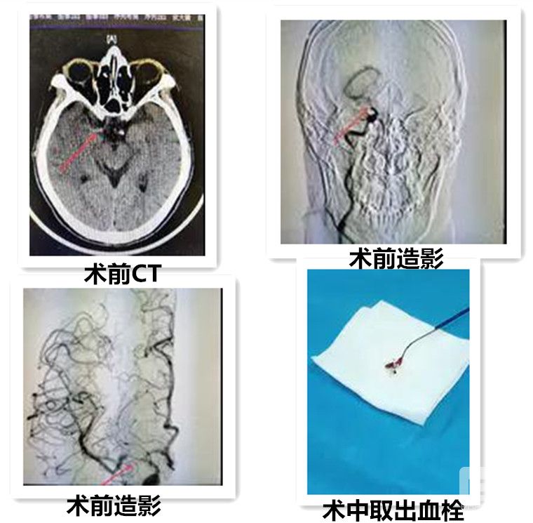 机械拉栓(拉栓结构图)